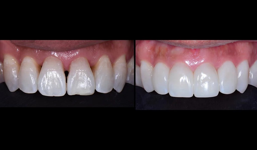 How Bioclear Empowers Dentists To Treat Black Triangles Optident